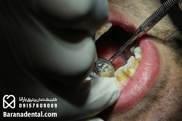 معاینه اولیه جرم گیری دندان