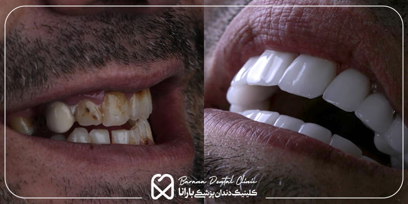 عکس قبل و بعد لمینت دندان در مشهد