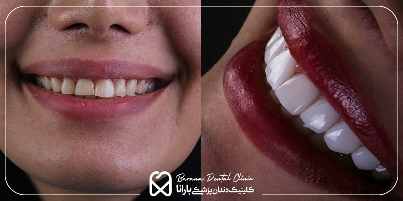 عکس قبل و بعد کامپوزیت دندان در مشهد