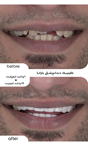 عکس قبل و بعد لمینت و ایمپلنت دندان در مشهد