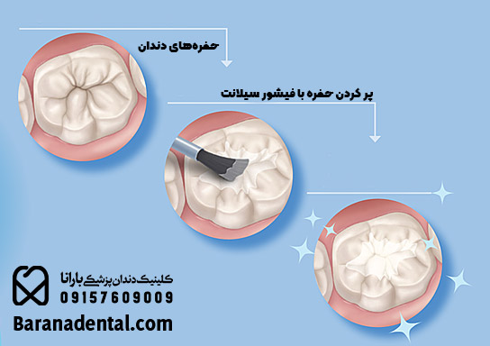 فیشور سیلانت دندان چگونه انجام میشود