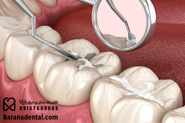 مراقبت های بعد از فیشور سیلنت دندان