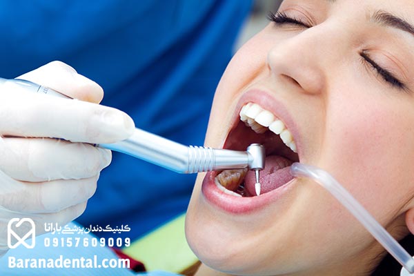 اهمیت جرم گیری ایمپلنت دندان