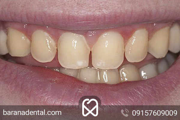 عوامل فرسایش مینای دندان