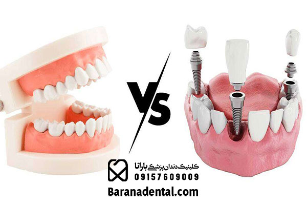 مقایسه پروتز دندان و ایمپلنت