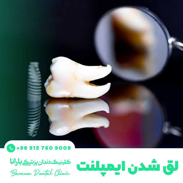 لق شدن ایمپلنت دندان | علت، پیشگیری و درمان