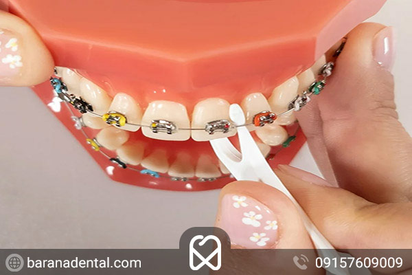 استفاده از نخ دندان همزمان با ارتودنسی