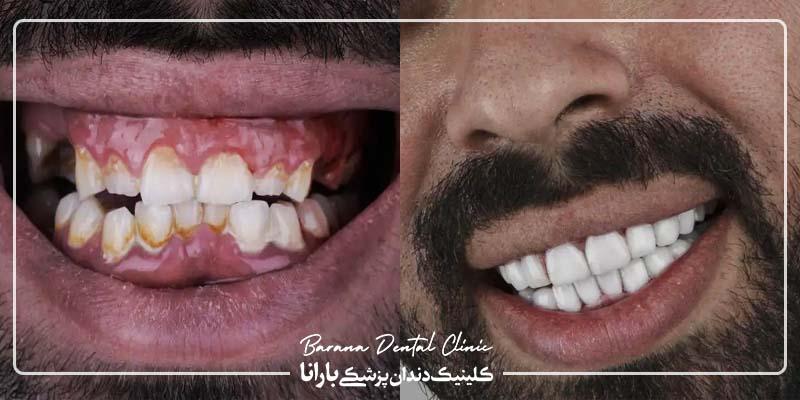 تفاوت قبل و بعد از لمینت دندان