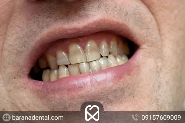 لکه های سفید یا زرد یکی از نشانه های فرسایش مینای دندان