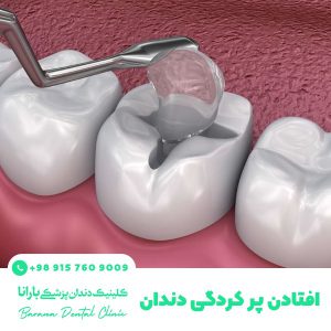 جدا شدن پر شدگی دندان