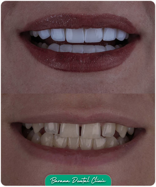 کامپوزیت ونیر دندانپزشکی بارانا