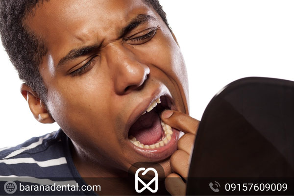 لق شدن دندان، یکی از عوارض جرم گیری لثه
