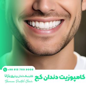 کامپوزیت برای اصلاح دندان کج