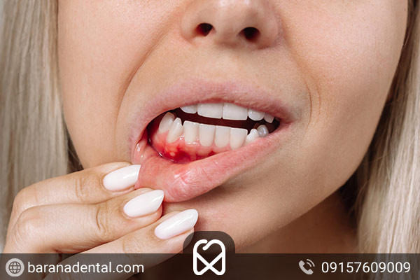 خونریزی لثه به علت جرم دندان