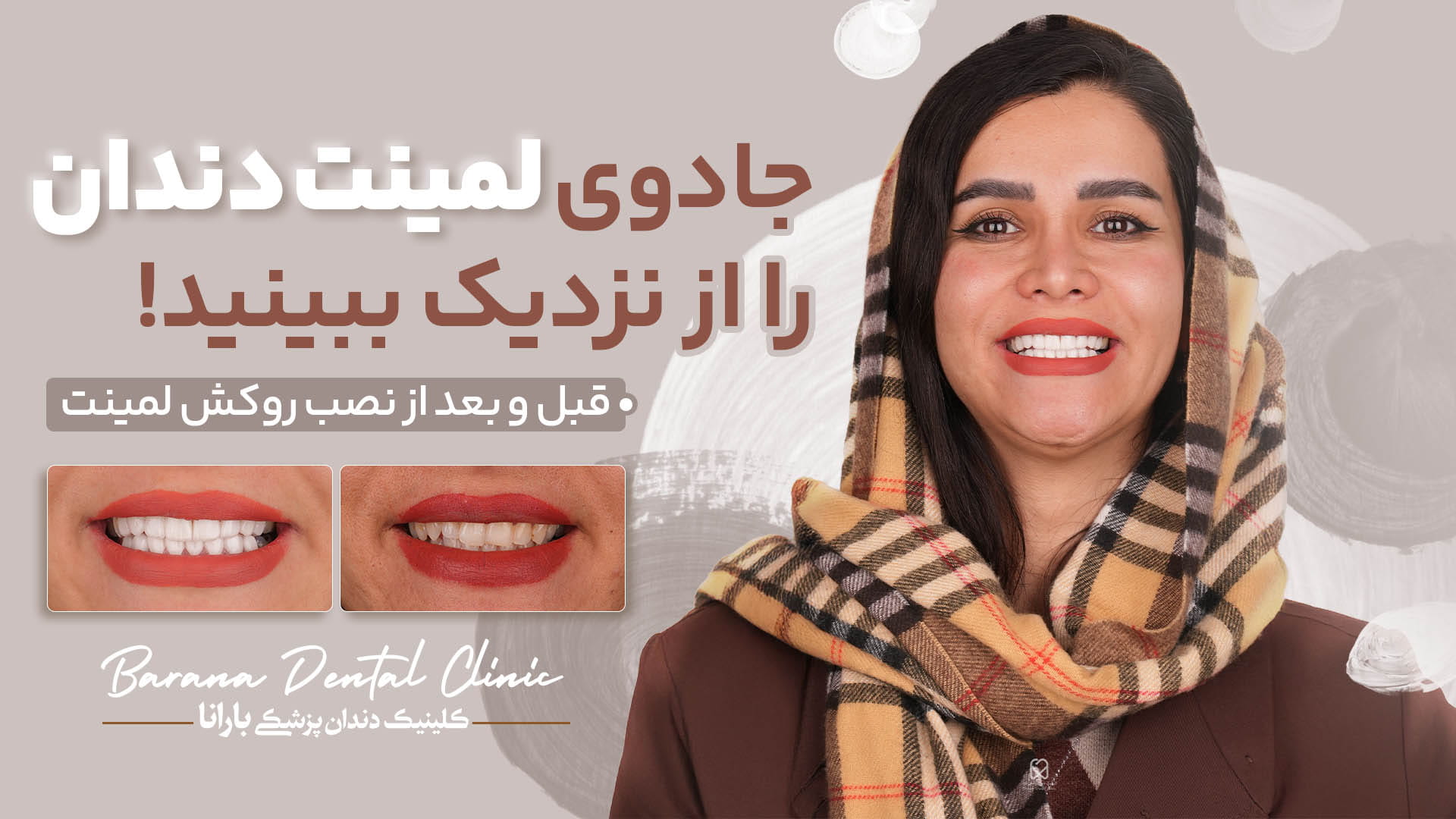 اصلاح عدم تقارن با لمینیت